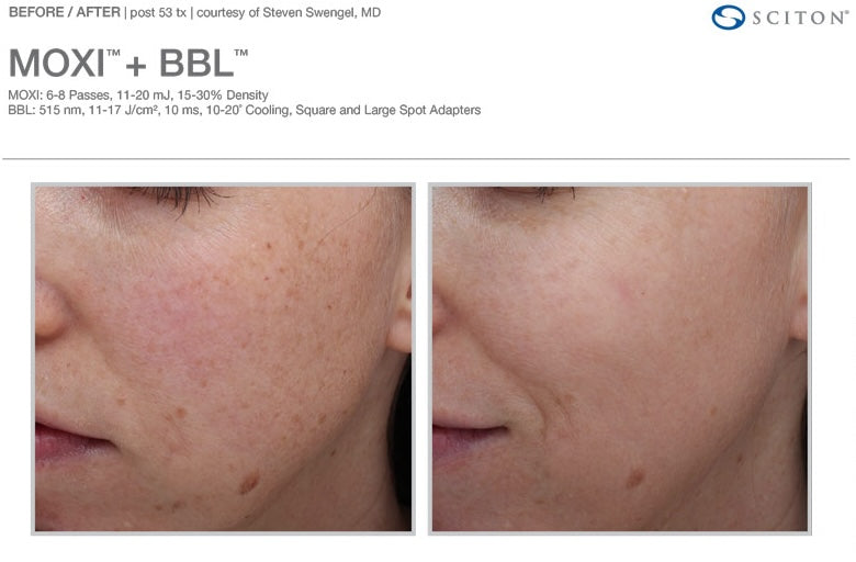 Before and after laser facial treatment showing smoother texture, brighter skin tone, and refined complexion at Bella Santé Med Spa in Boston