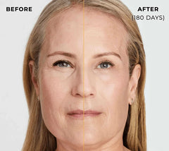 Lift & Firm Your Skin With Ultherapy