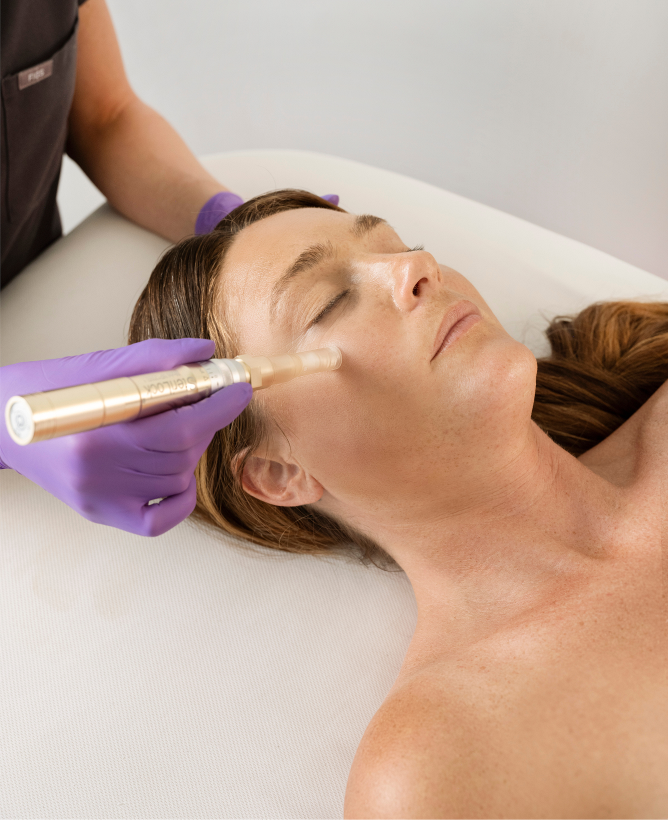 Microneedling for acne scars treatment at Bella Santé