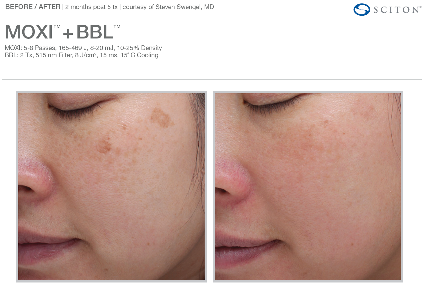 Unretouched Image of a Woman Taken Before and After 60 Days Of Moxi and BBL Hero Laser Treatment