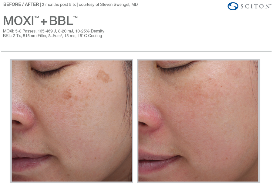 Unretouched Image of a Woman Taken Before and After 60 Days Of Moxi and BBL Hero Laser Treatment