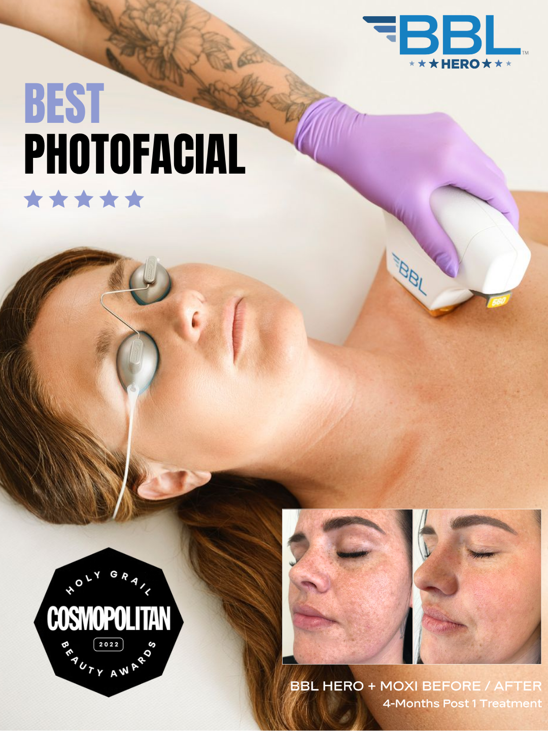 Person receiving a BBL Hero treatment at Bella Santé med spa for sun damage, redness, and uneven skin tone with before and after photos.