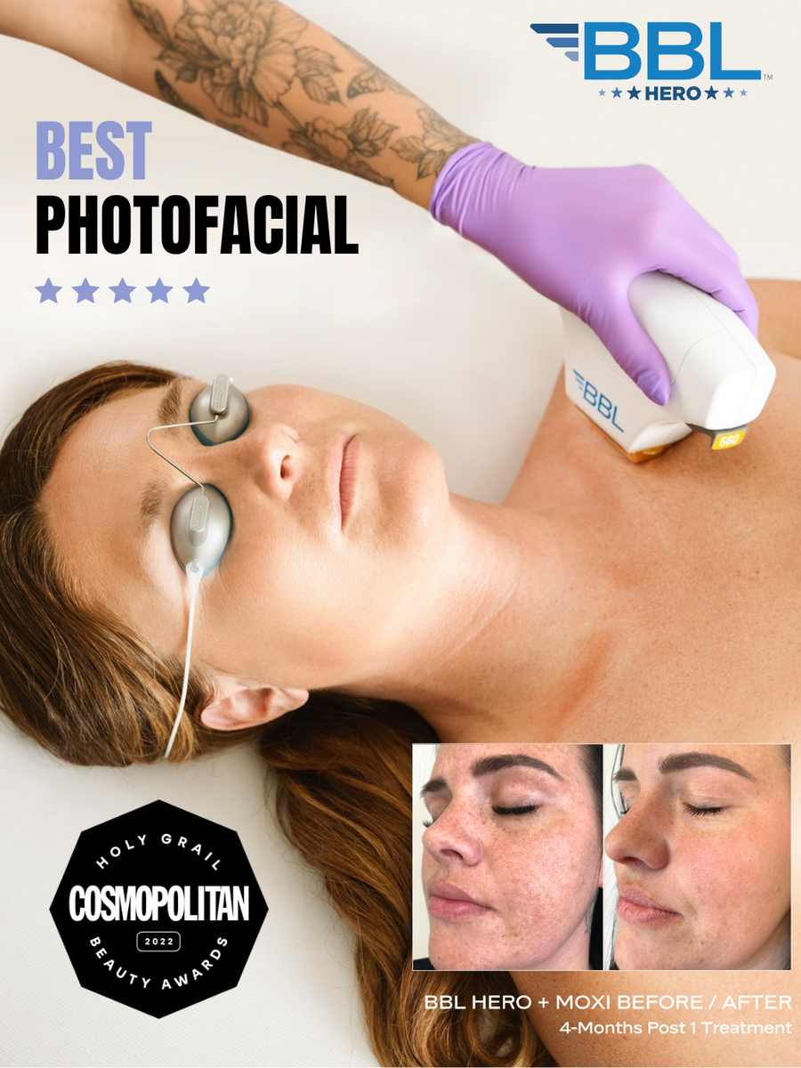 Person receiving a BBL Hero treatment at Bella Santé med spa for sun damage, redness, and uneven skin tone with before and after photos.