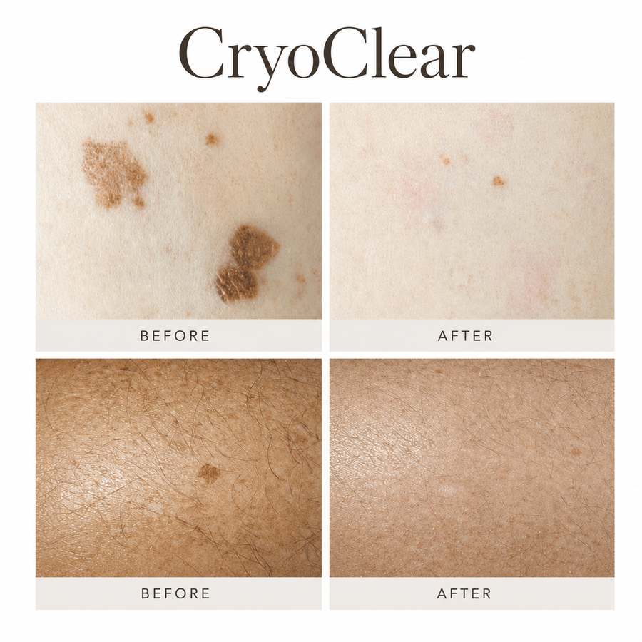 CryoClear before-and-after results for skin tags and age spots