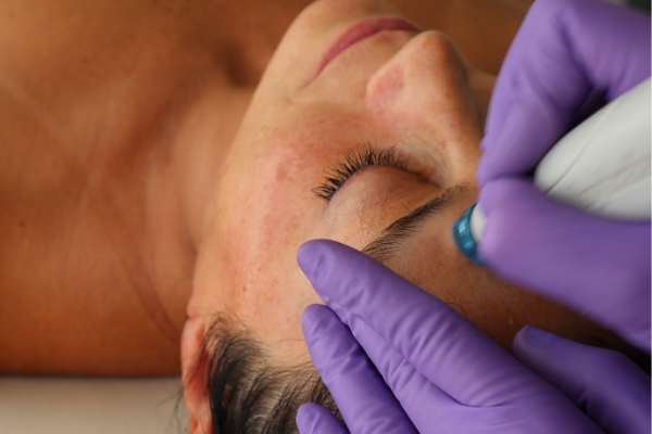 Guest receiving a HydraFacial treatment at Bella Santé for refreshed summer skin