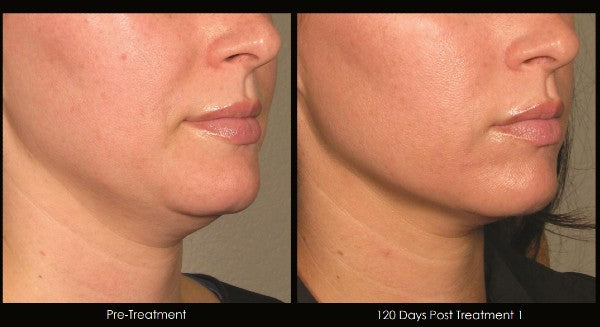 Ultherapy before and after photos showing the chin, under-chin area, and neck following skin tightening treatment.