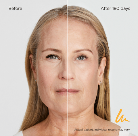 Turn Back Time With Ultherapy