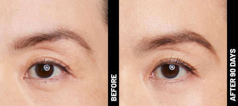 Ultherapy: Enjoy a Complimentary Brow Lift